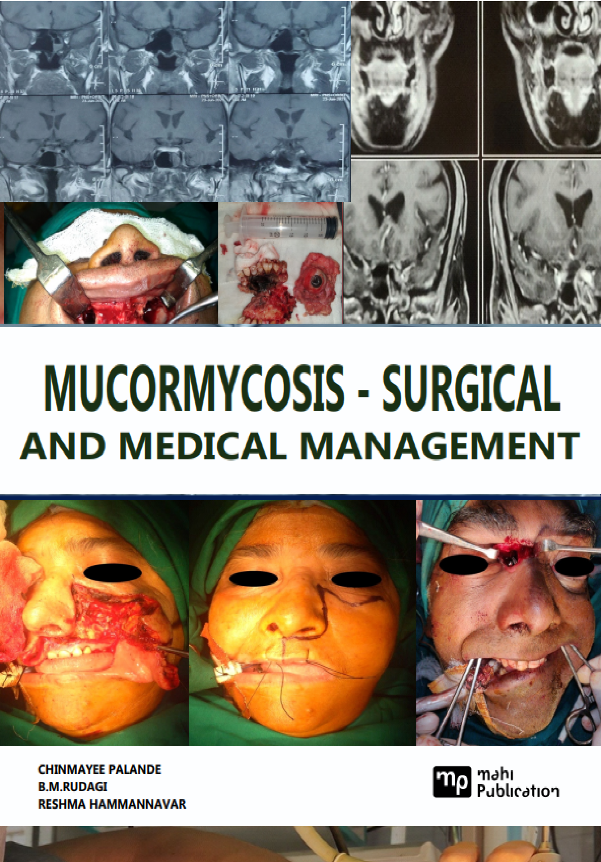 Mucormycosis - Surgical And Medical Management