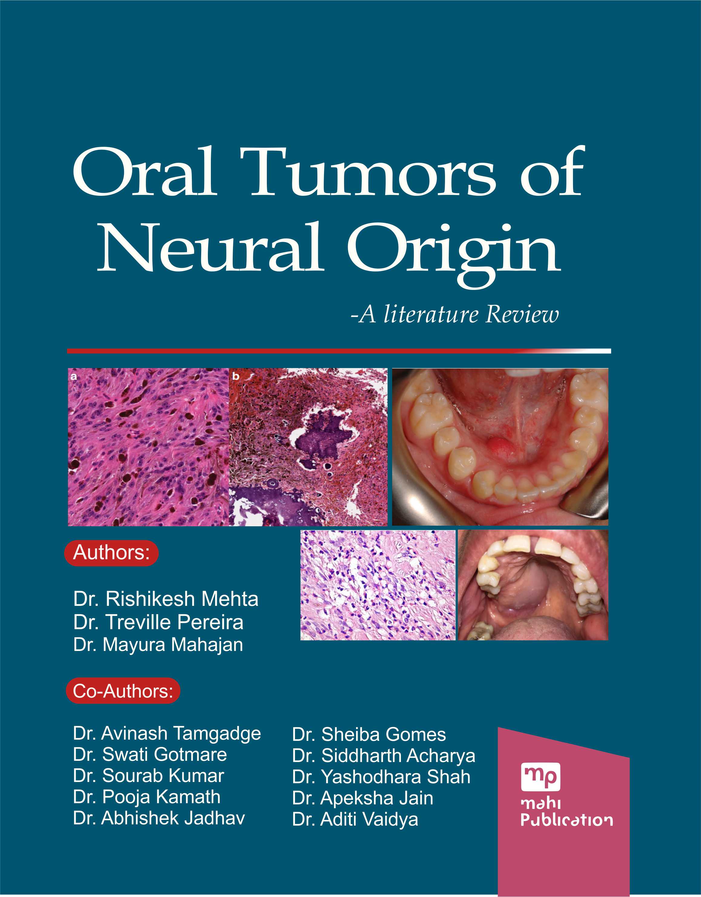Oral Tumors of Neural Origin - A Literature Review